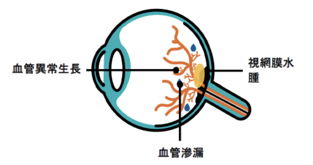 黃斑部病變-玻璃體注射-文山上明眼科