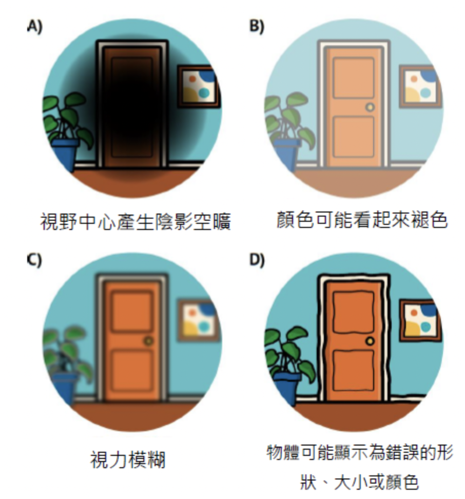 黃斑部病變-玻璃體注射-文山上明眼科